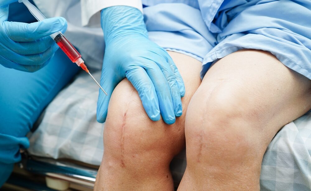 Platelet-Rich Plasma (PRP)