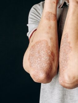 Psoriatic Arthritis