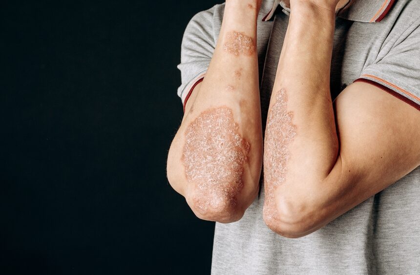 Psoriatic Arthritis