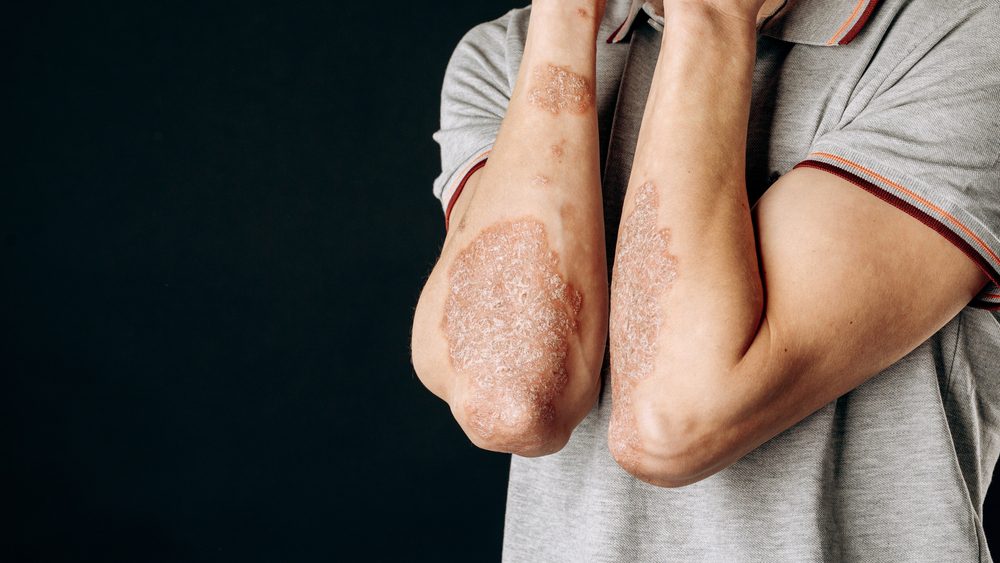 Psoriatic Arthritis
