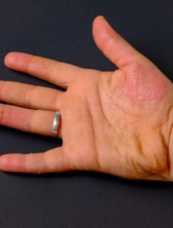 Sjögren’s Syndrome