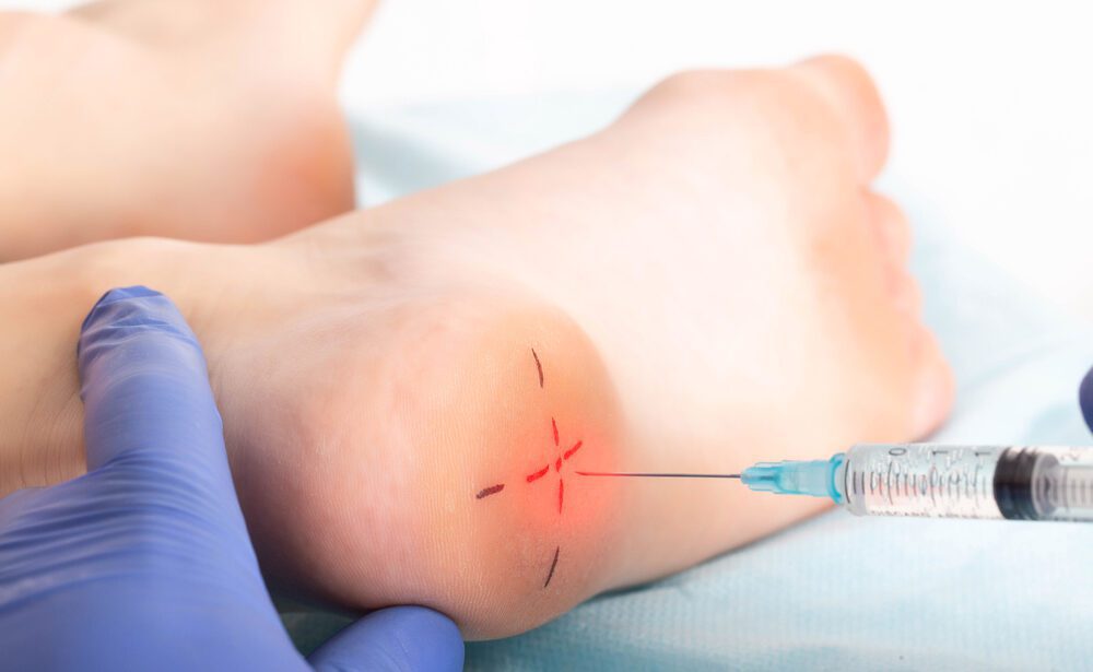 Steroid injections