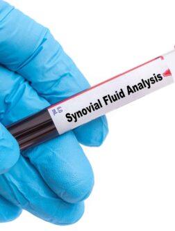 Synovial Fluid Analysis
