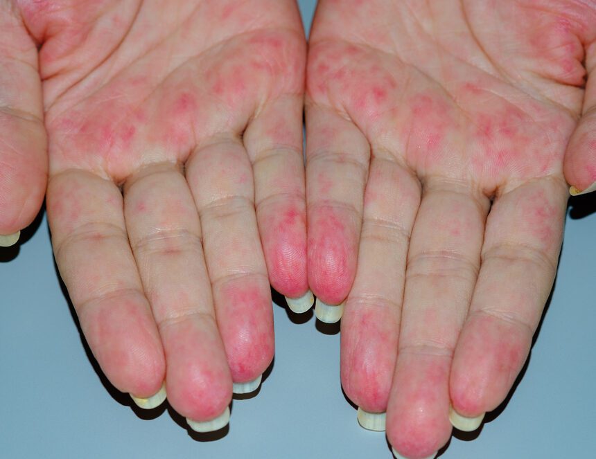 Vasculitis
