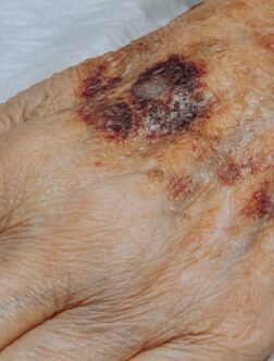 Complicated Autoimmune Connective Tissue Diseases