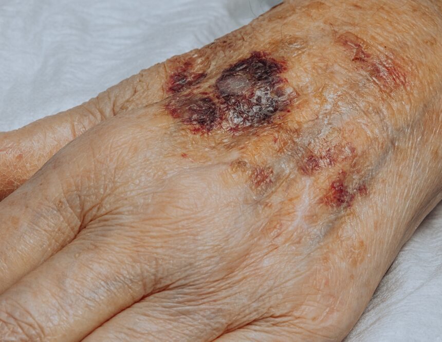 Complicated Autoimmune Connective Tissue Diseases