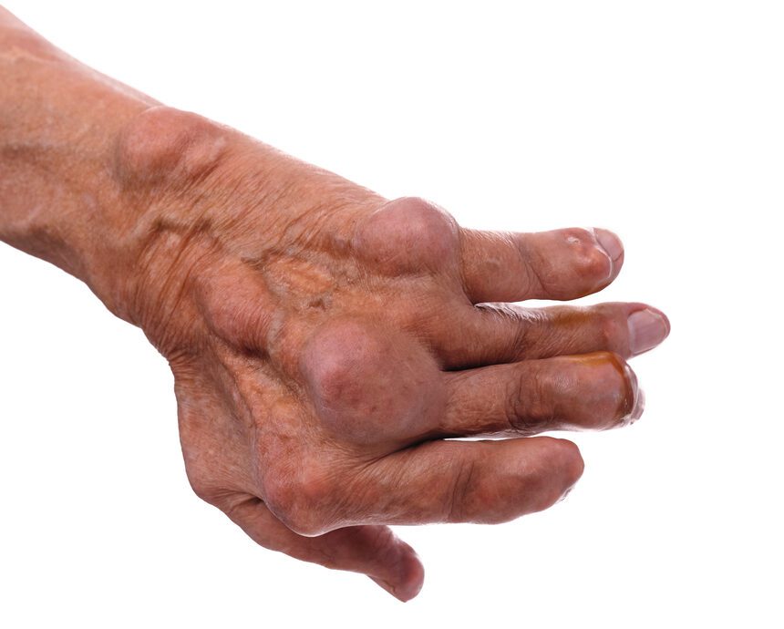 Infectious Arthritis