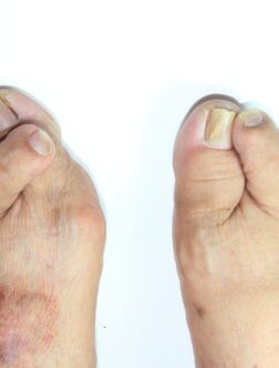 Overlap Disorders